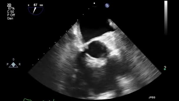 Hochwertige Video Ultraschall Transesophagealuntersuchung Des Herzens — Stockvideo