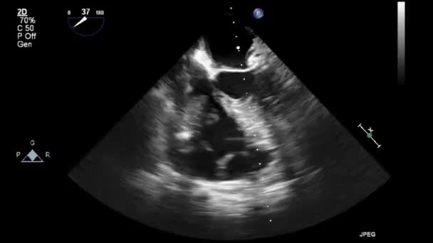 Hoge Kwaliteit Video Echografie Transslokdarmonderzoek Van Het Hart — Stockvideo