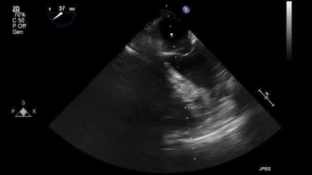 Examen Transesofágico Por Ultrasonido Video Alta Calidad Del Corazón — Vídeos de Stock