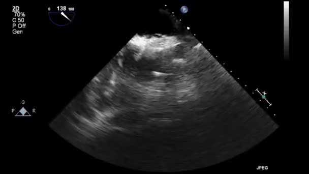 Examen Transesofágico Por Ultrasonido Video Alta Calidad Del Corazón — Vídeos de Stock