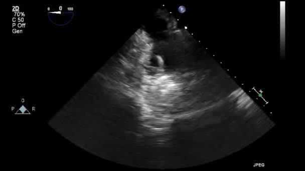 Vídeo Ultra Som Alta Qualidade Exame Transesofágico Coração — Vídeo de Stock