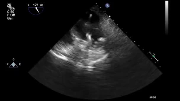 Examen Transesofágico Por Ultrasonido Video Alta Calidad Del Corazón — Vídeos de Stock