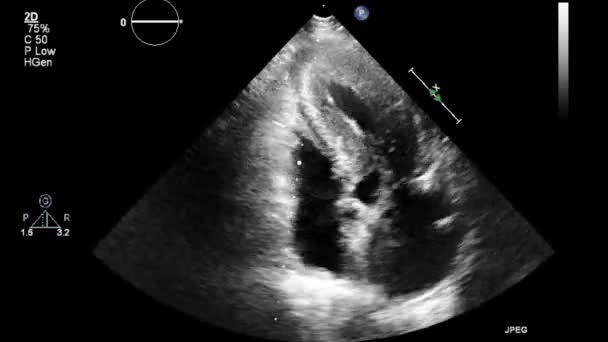 Examen Transesofágico Por Ultrasonido Video Alta Calidad Del Corazón — Vídeos de Stock