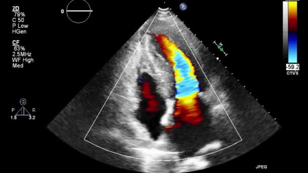 Examen Transesofágico Por Ultrasonido Video Alta Calidad Del Corazón — Vídeo de stock