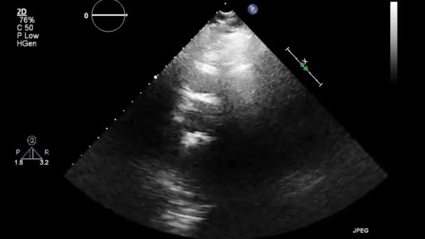 Hoge Kwaliteit Video Echografie Transslokdarmonderzoek Van Het Hart — Stockvideo