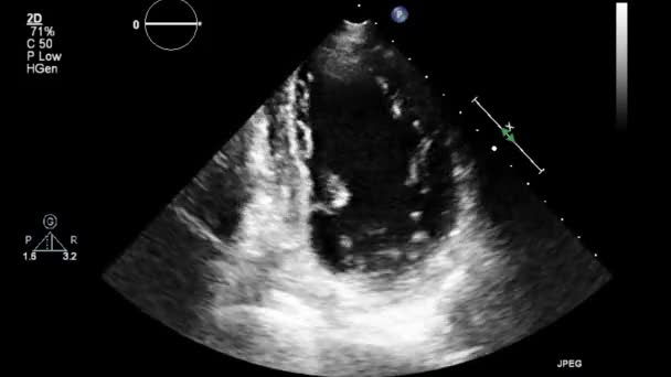 Examen Transesofágico Por Ultrasonido Video Alta Calidad Del Corazón — Vídeos de Stock