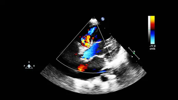 Immagine Del Cuore Durante Ecografia Transesofagea Con Modalità Doppler — Foto Stock