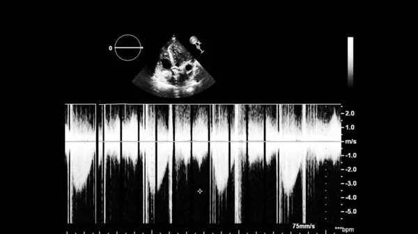 Afbeelding Van Het Hart Grijs Schaal Modus Tijdens Transesofageale Echografie — Stockfoto