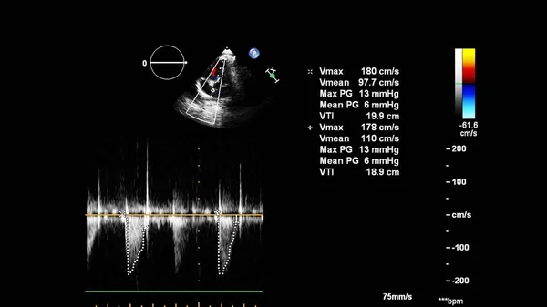 Image Cœur Mode Gris Lors Une Échographie Transœsophagienne — Photo