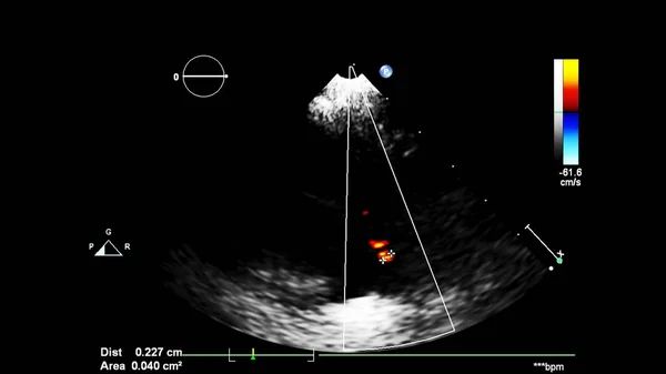 Image Heart Gray Scale Mode Transesophageal Ultrasound — Stock Photo, Image