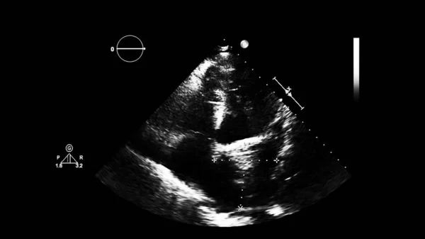 Image of the heart in gray-scale mode during transesophageal ultrasound.