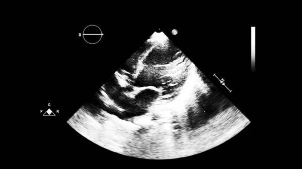 Afbeelding Van Het Hart Grijs Schaal Modus Tijdens Transesofageale Echografie — Stockfoto