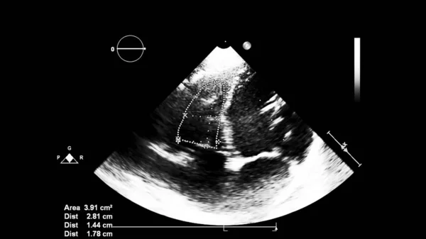 经食管超声下灰度型心脏影像学 — 图库照片