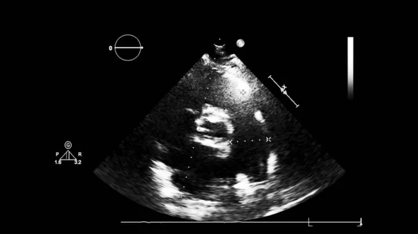 経食道超音波検査時のグレースケールモードで心臓の画像 — ストック写真
