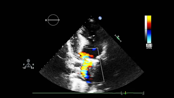 Image Cœur Mode Gris Lors Une Échographie Transœsophagienne — Photo