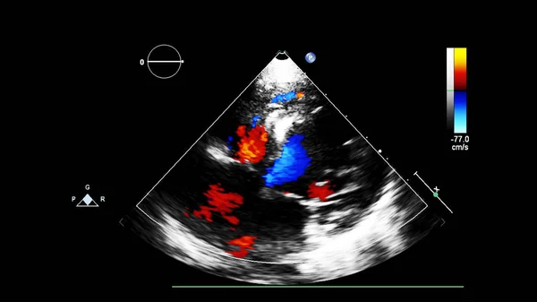 Immagine Del Cuore Durante Ecografia Transesofagea Con Modalità Doppler — Foto Stock