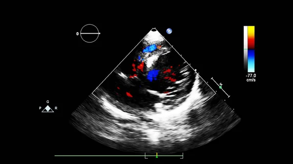 Bild Des Herzens Beim Transesophagealen Ultraschall Mit Doppler Modus — Stockfoto