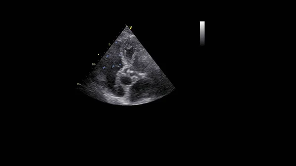 Transesofageal Ultrason Sırasında Kalbin Gri Ölçekli Görüntüsü — Stok fotoğraf