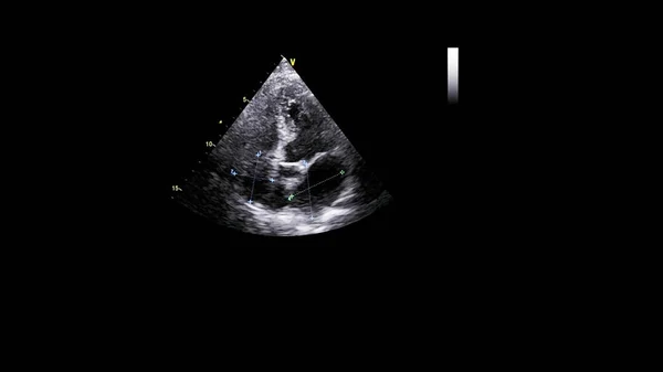 Transesofageal Ultrason Sırasında Kalbin Gri Ölçekli Görüntüsü — Stok fotoğraf