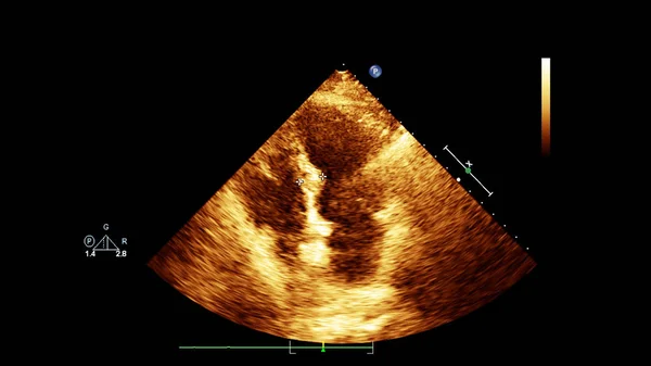 Image of the heart in gray-scale mode during transesophageal ultrasound.