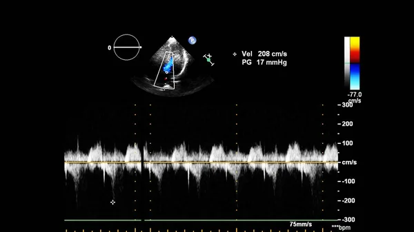 Изображение Сердца Сером Режиме Время Трансофагеального Ультразвука — стоковое фото