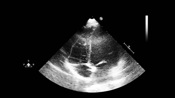 経食道超音波検査時のグレースケールモードで心臓の画像 — ストック写真