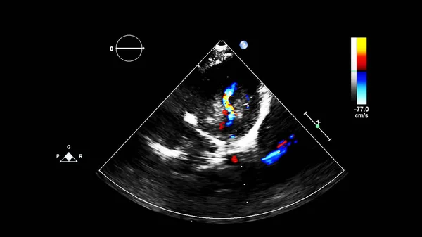 Immagine Del Cuore Durante Ecografia Transesofagea Con Modalità Doppler — Foto Stock