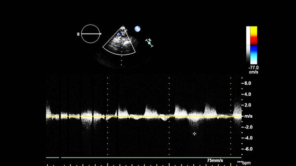 Image of the heart in gray-scale mode during transesophageal ultrasound.