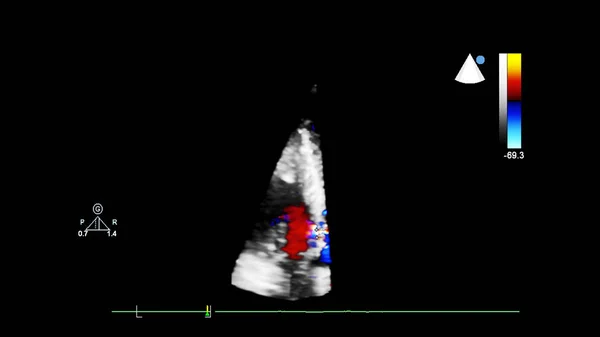 Screen of an ultrasound machine with a 3D image of a heart