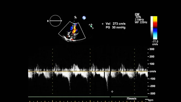 Imagem Coração Durante Ultrassom Transesofágico Com Modo Doppler — Fotografia de Stock