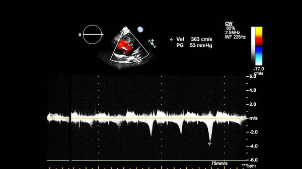 Imagen Del Corazón Durante Ecografía Transesofágica Con Modo Doppler — Foto de Stock