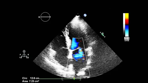Image Heart Transesophageal Ultrasound Doppler Mode — Stock Photo, Image