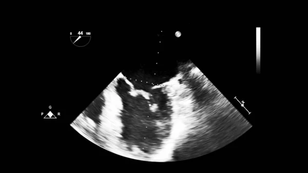 Afbeelding Van Het Hart Grijs Schaal Modus Tijdens Transesofageale Echografie — Stockfoto