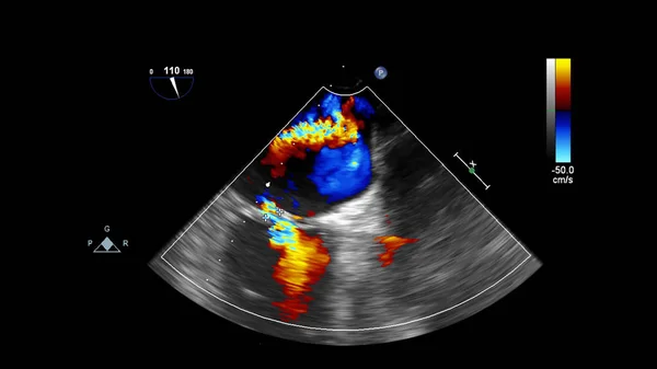 Immagine Del Cuore Durante Ecografia Transesofagea Con Modalità Doppler — Foto Stock