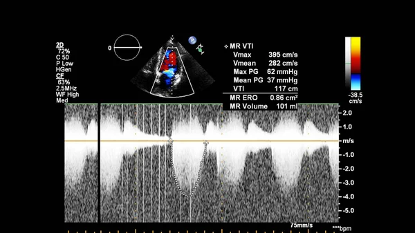 Изображение Сердца Время Трансофагеального Ультразвука Доплеровским Режимом — стоковое фото