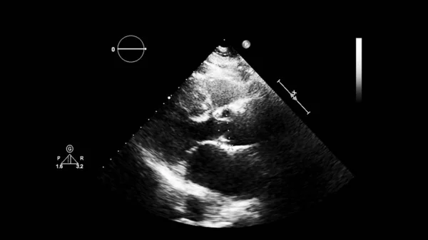 Transesofageal Ultrason Sırasında Kalbin Gri Ölçekli Görüntüsü — Stok fotoğraf