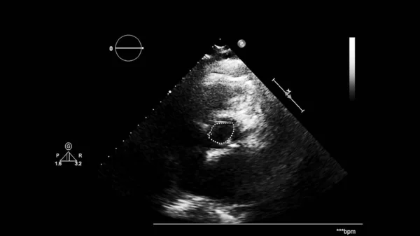 Transesofageal Ultrason Sırasında Kalbin Gri Ölçekli Görüntüsü — Stok fotoğraf