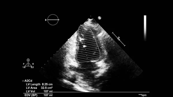 Image Cœur Mode Gris Lors Une Échographie Transœsophagienne — Photo