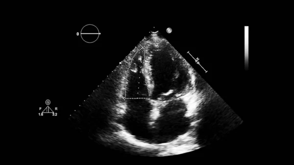 Image Heart Gray Scale Mode Transesophageal Ultrasound — Stock Photo, Image