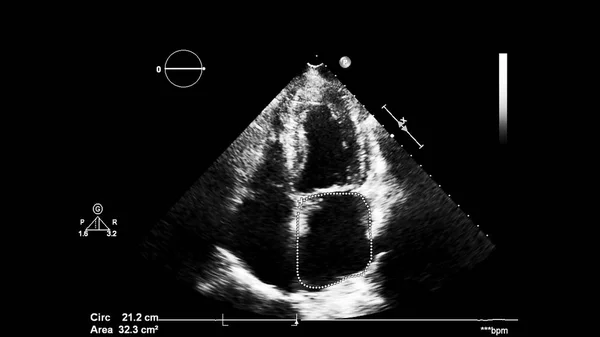 Obrázek Srdce Šedém Měřítku Během Transesofageálního Ultrazvuku — Stock fotografie