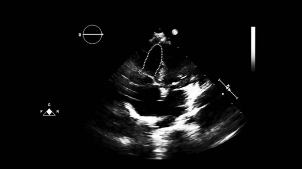 Image of the heart in gray-scale mode during transesophageal ultrasound.