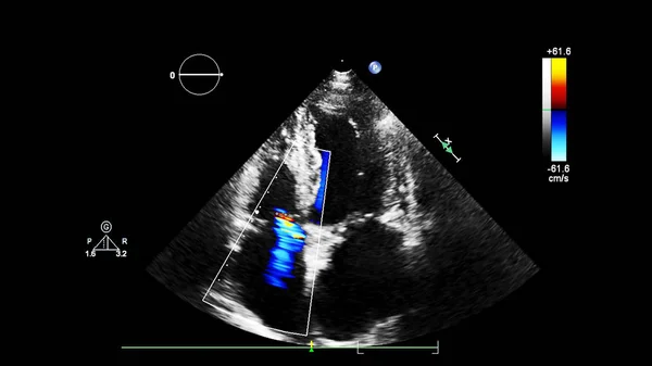 Imagem Coração Durante Ultrassom Transesofágico Com Modo Doppler — Fotografia de Stock