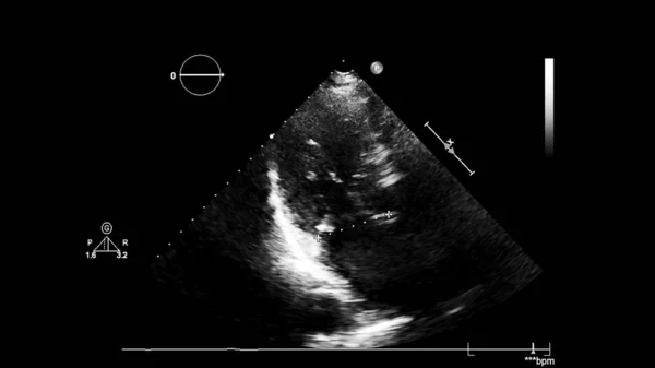 Image of the heart in gray-scale mode during transesophageal ultrasound.