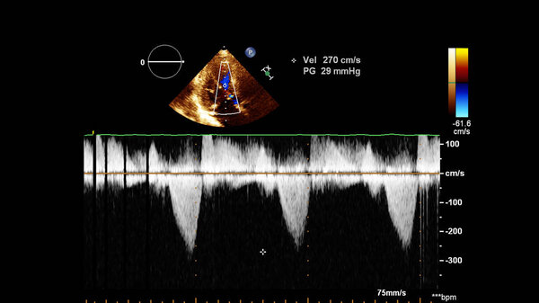 Image of the heart during transesophageal ultrasound with Doppler mode.