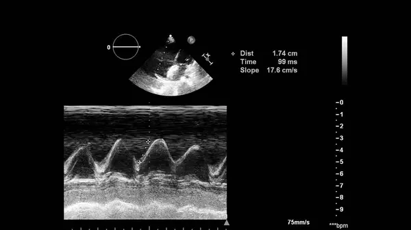 Image of the heart in gray-scale mode during transesophageal ultrasound.