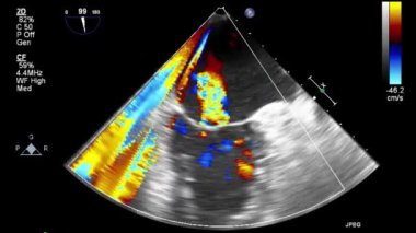Kalbin yüksek kaliteli ultrason transsofageal muayenesi..