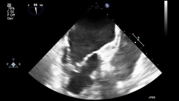 Examen Transesofágico Por Ultrasonido Video Alta Calidad Del Corazón — Vídeo de stock