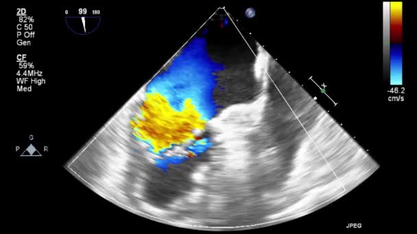 Examen Transesofágico Por Ultrasonido Video Alta Calidad Del Corazón — Vídeos de Stock