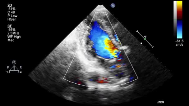 High Quality Video Ultrasound Transesophageal Examination Heart — Stock Video