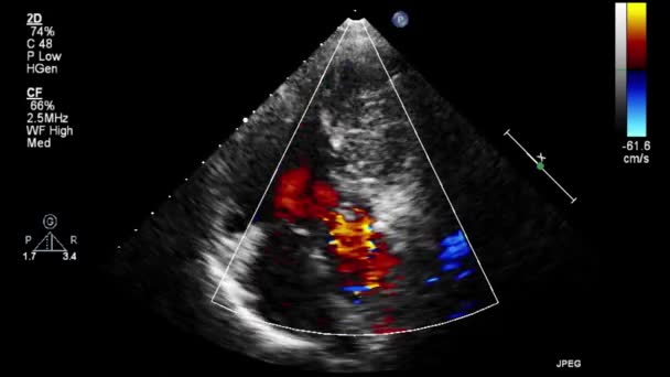 Vídeo Ultra Som Alta Qualidade Exame Transesofágico Coração — Vídeo de Stock